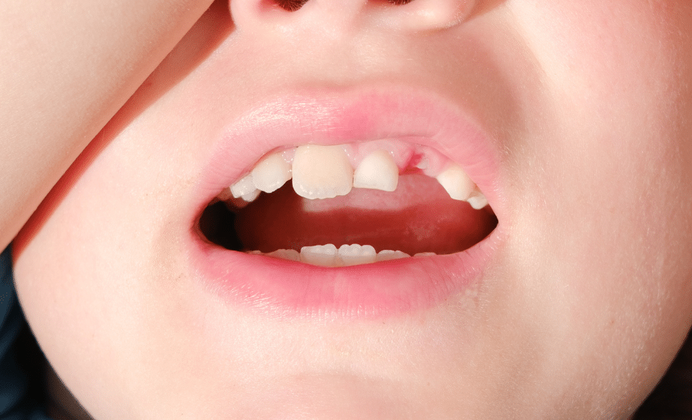 Knocked Out Teeth - Bridgepointe Family Dental