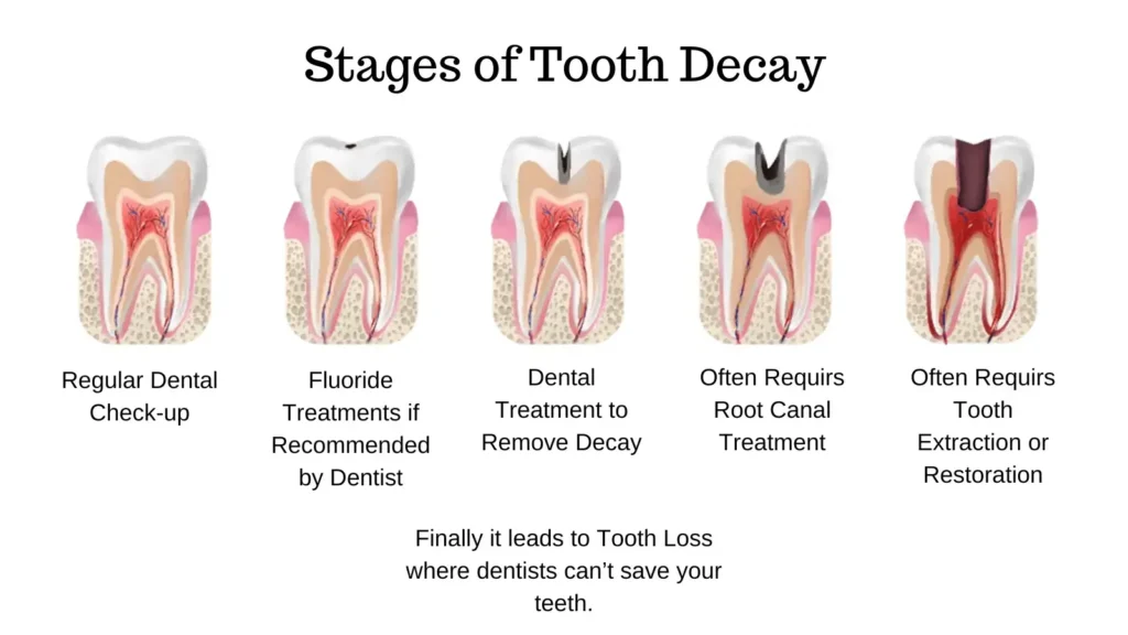 Graphical Representation of Step by Step Stages of Tooth Decay