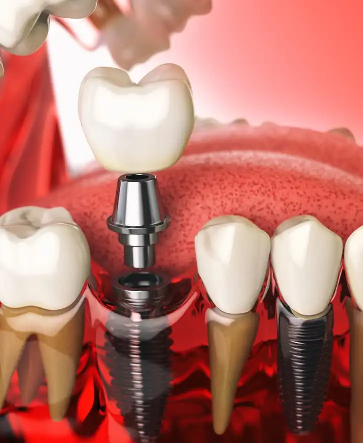 dental-implants-Metuchen, NJ