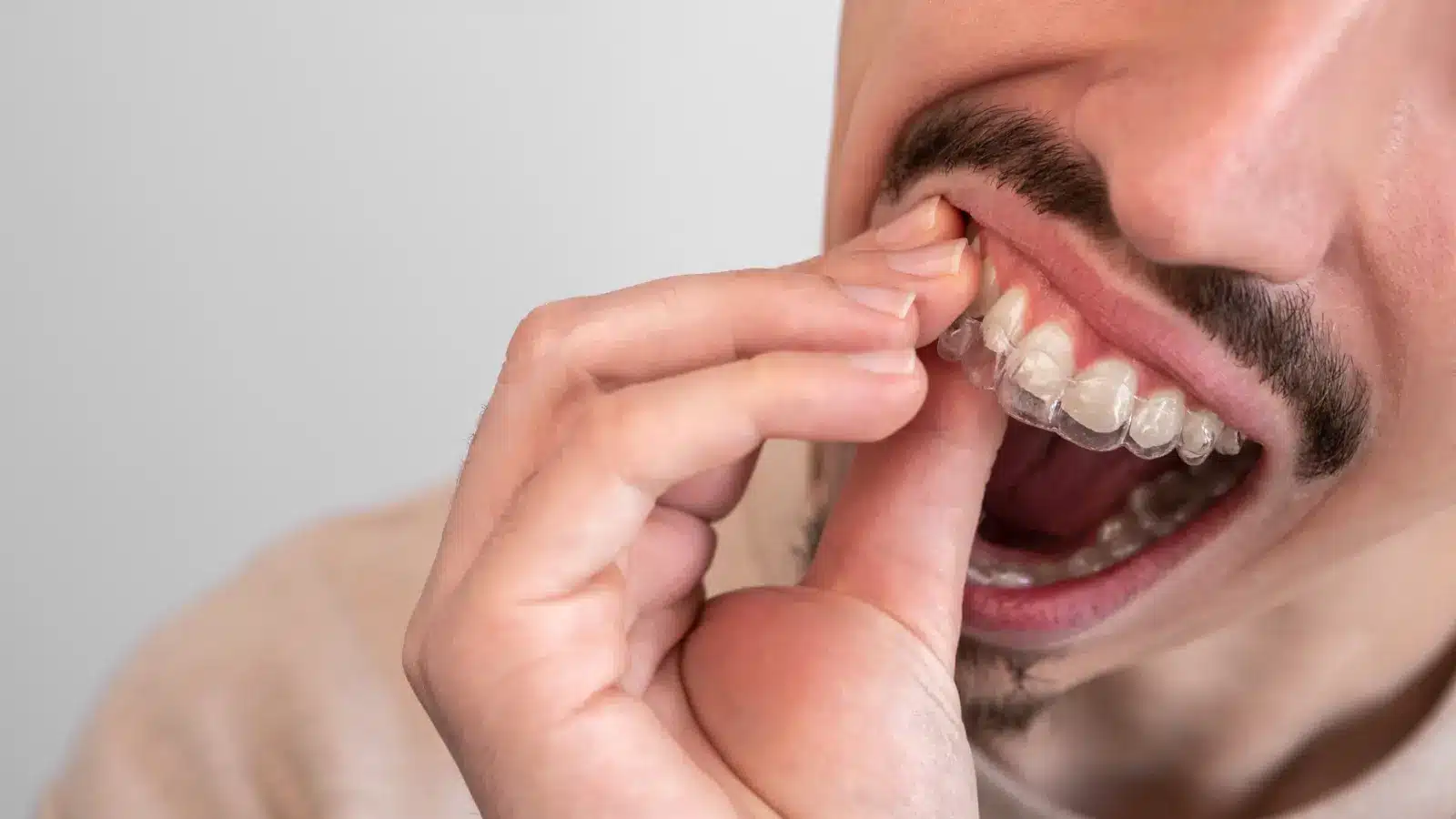 Transform Your Smile With Clear Aligners Today