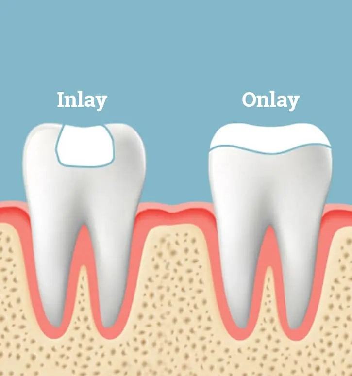 inlays and onlays metuchen nj