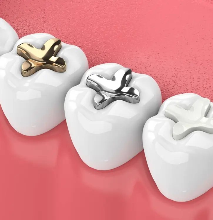 dental fillings dentist Metuchen NJ