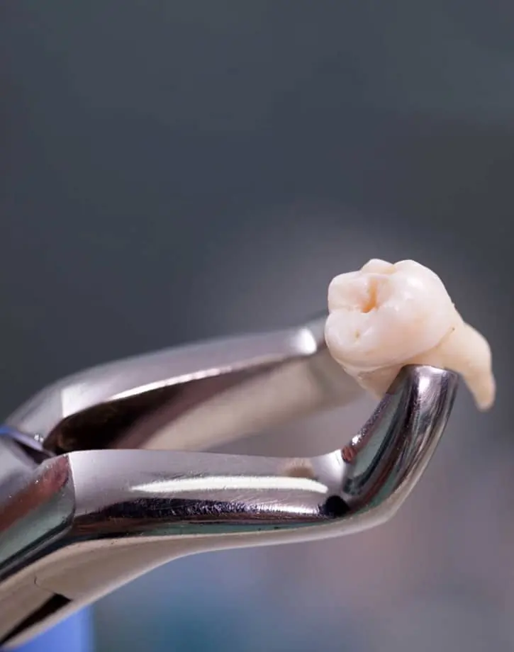 tooth extraction dentist Metuchen NJ